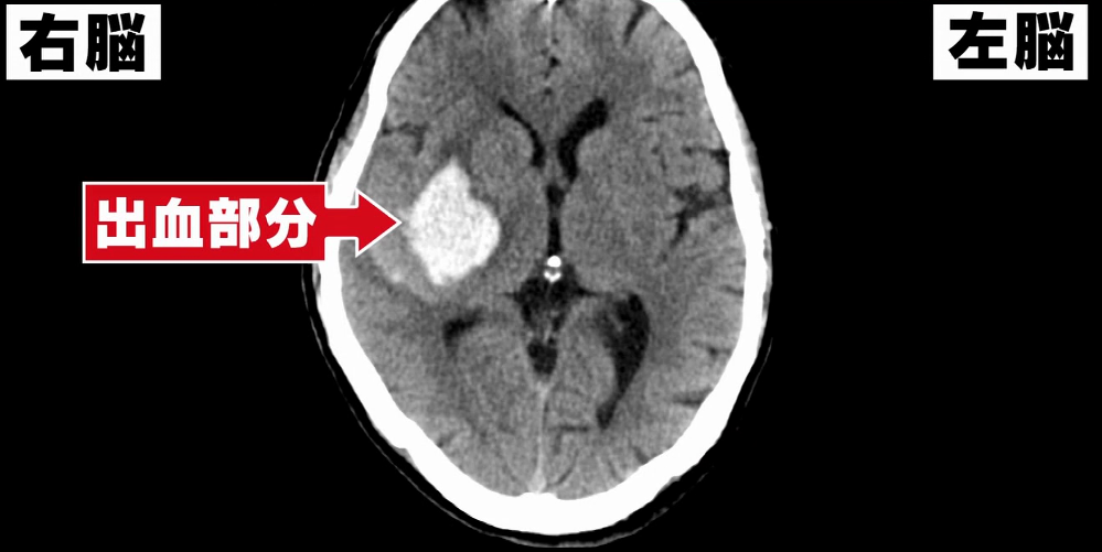 脳内出血のCT画像